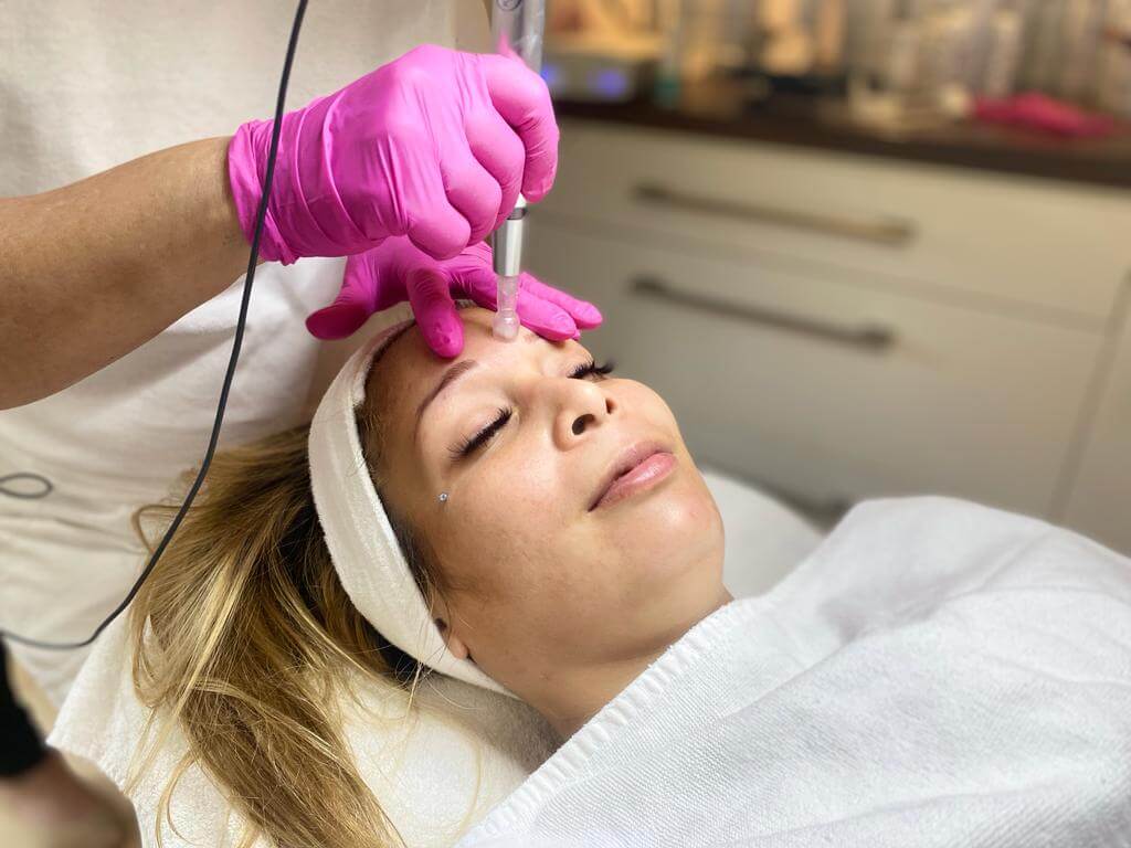 Microneedling im Einsatz bei einer Kundin von Dagmar Nitzschke im Hautnah Schönheitspflege Kosmetikstudio
